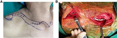 Application of a new sternoclavicular hook plate in bipolar clavicle injuries